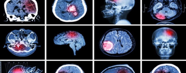 Types of Brain Injuries and 3 Levels of Severity